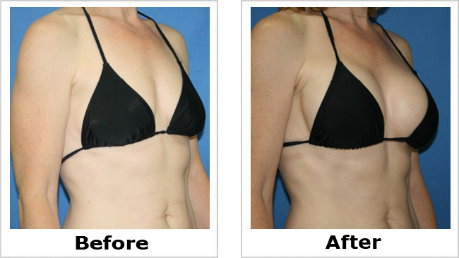 Before And After Breast Augmentation Procedure