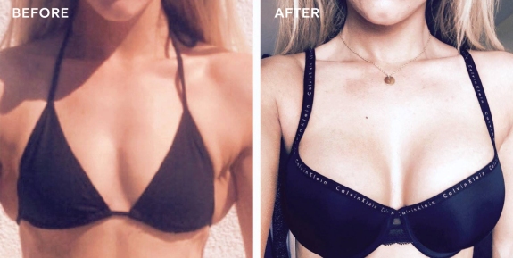 breast-augmentation-before-after.jpg