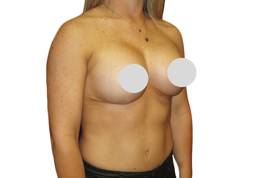 breast-lift-after-21